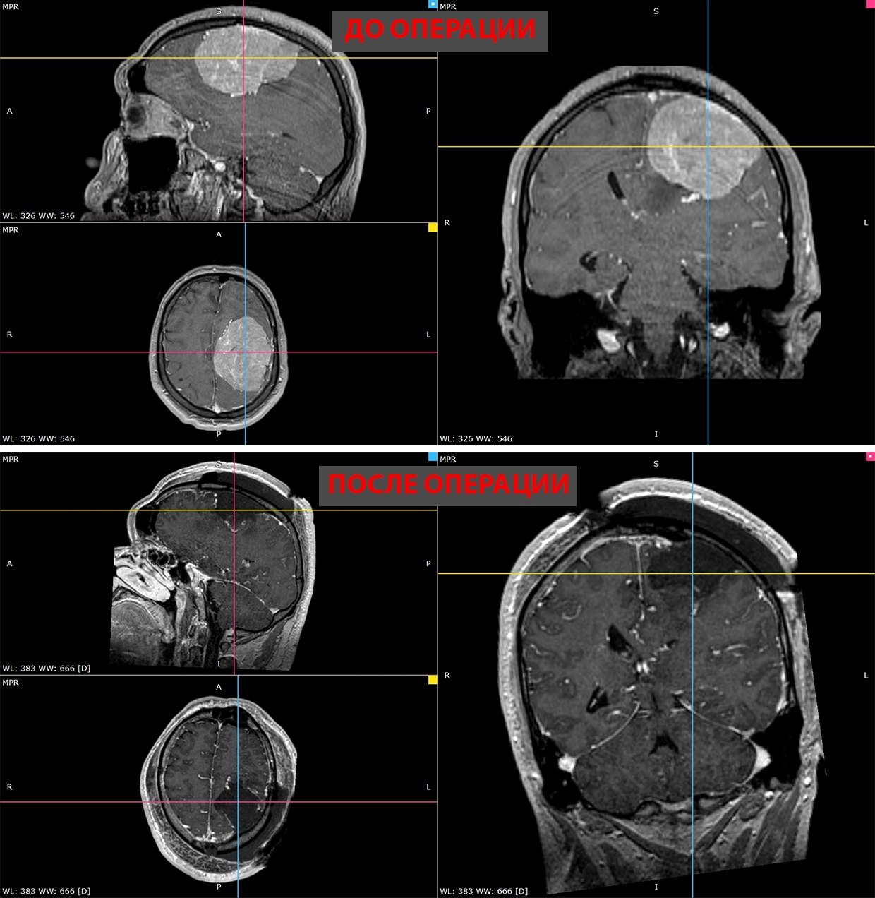 "Ему повсюду отказывали". Новосибирские хирурги удалили пациенту гигантскую опухоль головного мозга "Ему повсюду отказывали". Новосибирские хирурги удалили пациенту гигантскую опухоль головного мозга