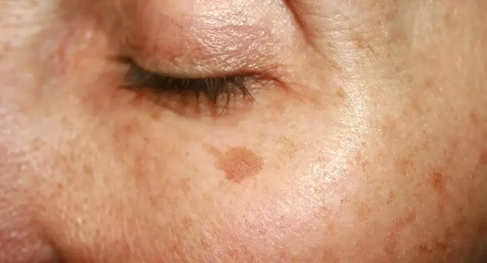 Как сохранить молодость кожи: 4 продукта для защиты от пигментации