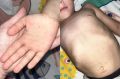 «Сыпь по всему телу, даже во рту»: в детсаду под Новосибирском дети массово заболели энтеровирусом