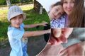 Девочка из Новосибирска родилась с кожей «бабочки» — врачи 9 лет не могут понять, что с ней