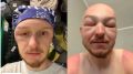 Последствия сапборда — раздутая голова