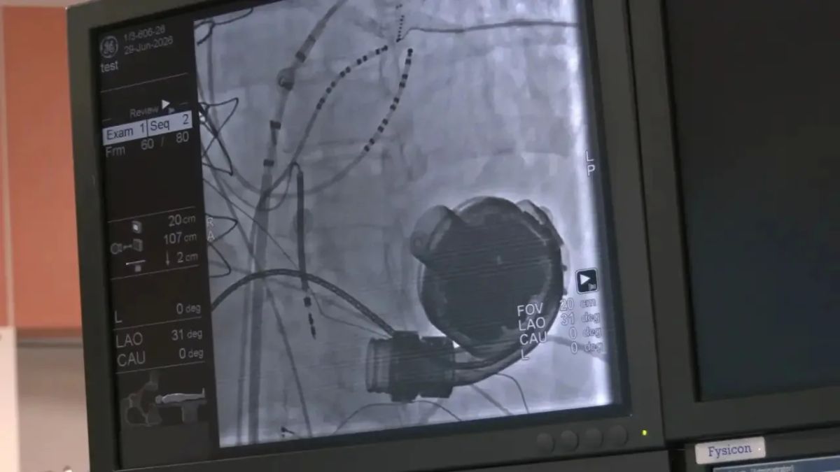 Новосибирской кардиохирурги провели уникальную операцию пациенту с «искусственным сердцем» Новосибирской кардиохирурги провели уникальную операцию пациенту с «искусственным сердцем»