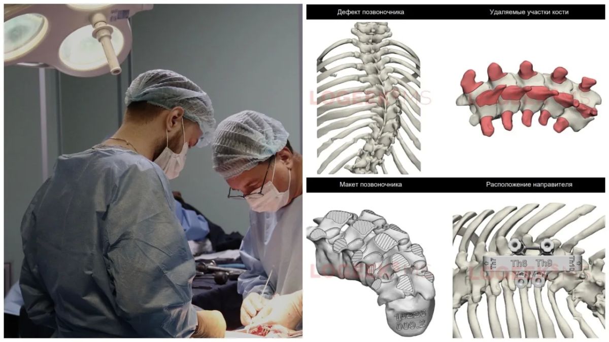 Новосибирские хирурги спасли девочку с помощью 3D-технологий